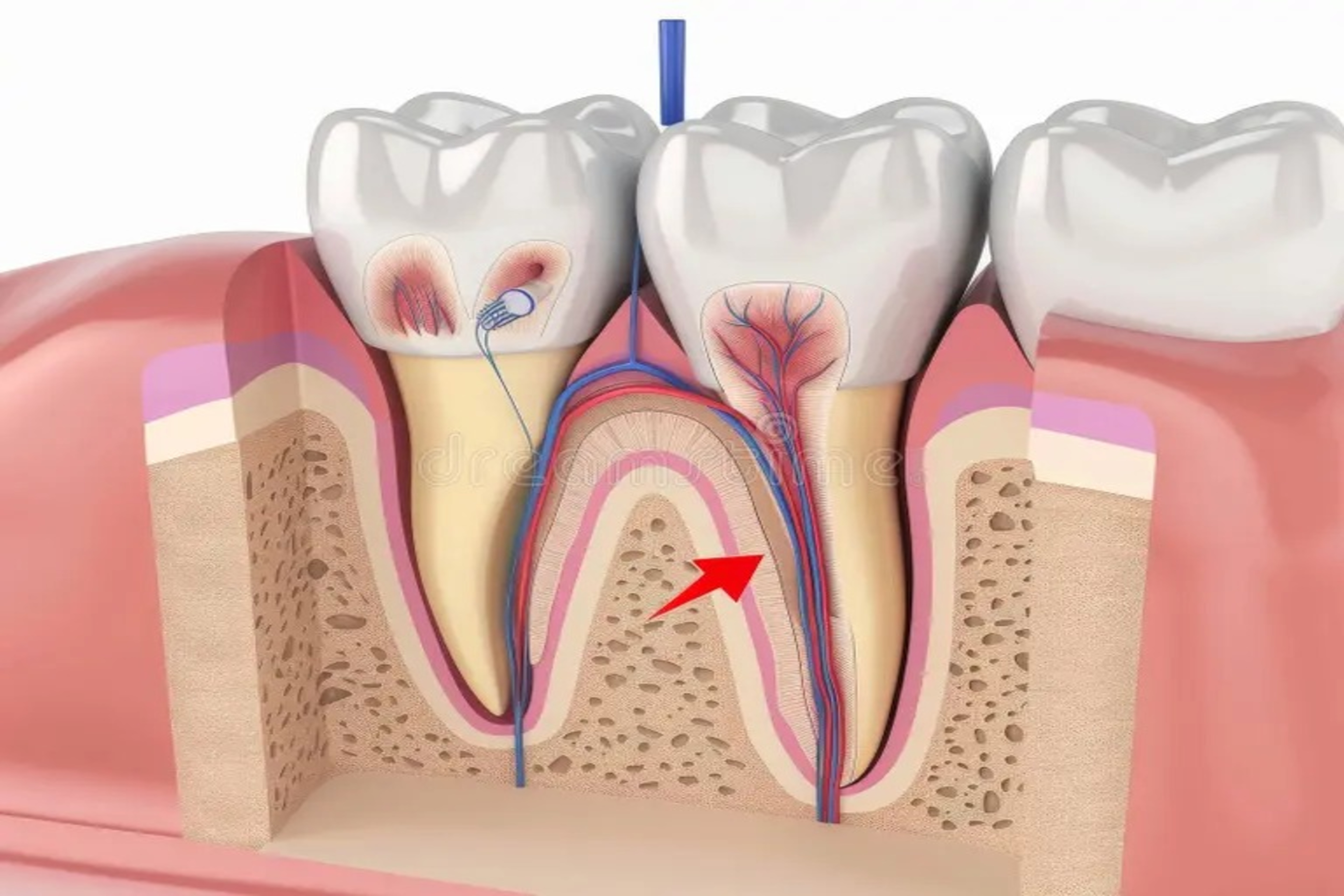 Root Canal